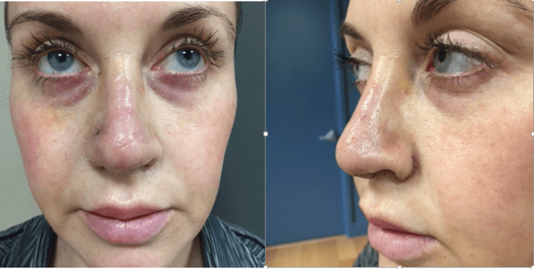 Before & after septoplasty San Francisco