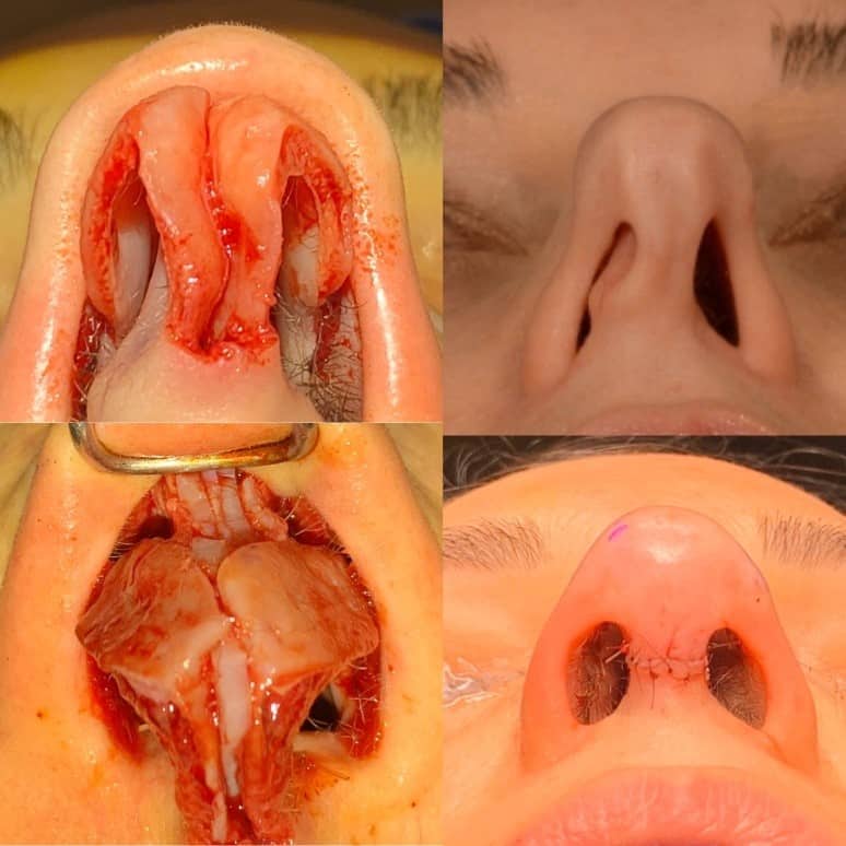 I am often asked by prospective patients if&nbsp;rhinoplasty&nbsp;will impair their ability to breathe through their nose.&nbsp; While this is a potential complication of rhinoplasty, I strongly believe that if done properly, rhinoplasty will typically