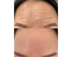 Before/After Botox & Dysport San Francisco