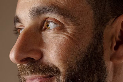 Eyelid surgery San Francisco