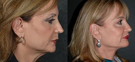 Facelift Results